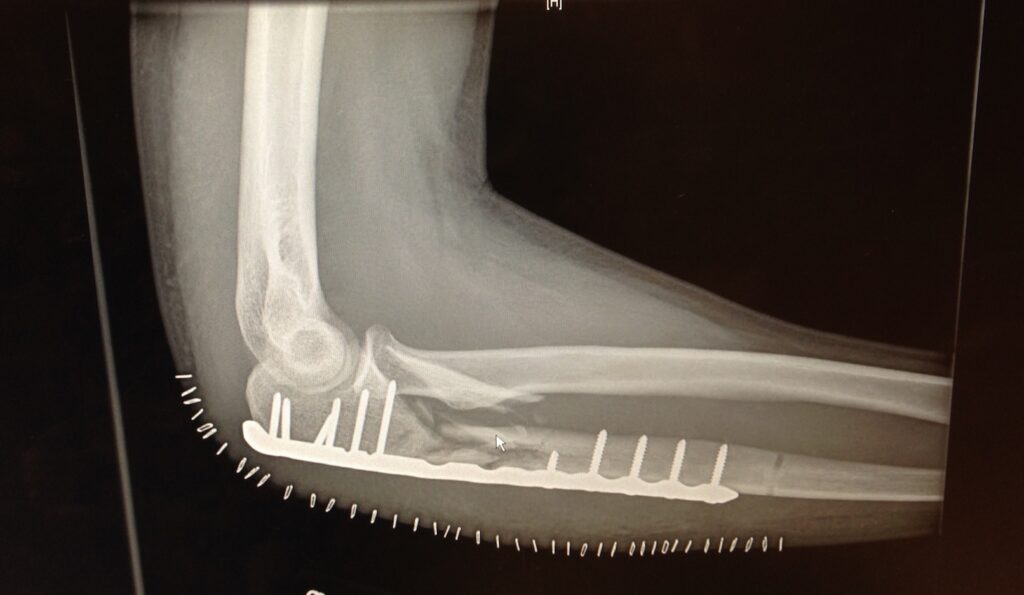 Xray of broken arm showing metal plate, screws, and staples.